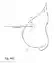 Fig. 12 - Removable localizing wire