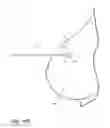 Fig. 13 - Removable localizing wire