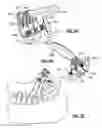 Fig. 04 - Instrument and method for spinal compression and distraction