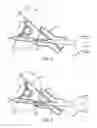 Fig. 06 - System and method for bone anchor removal