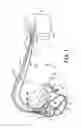 Fig. 02 - Atrial nerve stimulation with ventricular pacing