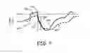 Fig. 07 - Atrial nerve stimulation with ventricular pacing