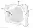Fig. 01 - Apparatus and method for treating obstructive sleep apnea