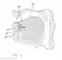 Fig. 08 - Apparatus and method for treating obstructive sleep apnea