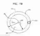 Fig. 20 - Twisting bifurcation delivery system