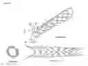 Fig. 25 - FLEXIBLE INTRALUMINAL STENT