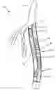 Fig. 01 - Differential dilation stent and method of use