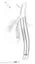 Fig. 02 - Differential dilation stent and method of use