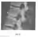 Fig. 06 - Method of using instruments and interbody spinal implants to enhance distraction