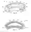 Fig. 13 - Method of using instruments and interbody spinal implants to enhance distraction