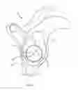 Fig. 07 - Circular glenoid method for shoulder arthroplasty
