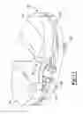 Fig. 11 - Knee prosthesis