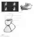 Fig. 03 - Method for (semi-) automatic dental implant planning