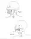 Fig. 07 - DEVICES, SYSTEMS AND METHODS USING MAGNETIC FORCE SYSTEMS AFFECTING THE TOUNGUE OR HYOID MUSCCLES IN THE UPPER AIRWYA