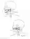 Fig. 08 - DEVICES, SYSTEMS AND METHODS USING MAGNETIC FORCE SYSTEMS AFFECTING THE TOUNGUE OR HYOID MUSCCLES IN THE UPPER AIRWYA
