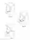 Fig. 09 - DEVICES, SYSTEMS AND METHODS USING MAGNETIC FORCE SYSTEMS AFFECTING THE TOUNGUE OR HYOID MUSCCLES IN THE UPPER AIRWYA