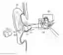 Fig. 01 - Hearing aid with a replaceable insertion cap
