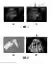 Fig. 02 - System and method for detection of acoustic shadows and automatic assessment of image usability in 3D ultrasound images