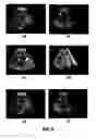 Fig. 07 - System and method for detection of acoustic shadows and automatic assessment of image usability in 3D ultrasound images