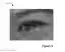 Fig. 19 - Red-eye removal using multiple recognition channels