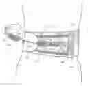 Fig. 01 - Double pull body brace