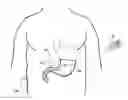 Fig. 01 - INTRAGASTRIC VOLUME OCCUPYING DEVICE WITH ACTIVE AGENTS
