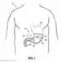 Fig. 02 - INTRAGASTRIC VOLUME OCCUPYING DEVICE WITH ACTIVE AGENTS