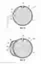 Fig. 03 - INTRAGASTRIC VOLUME OCCUPYING DEVICE WITH ACTIVE AGENTS