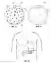 Fig. 08 - INTRAGASTRIC VOLUME OCCUPYING DEVICE WITH ACTIVE AGENTS