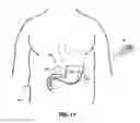 Fig. 11 - INTRAGASTRIC VOLUME OCCUPYING DEVICE WITH ACTIVE AGENTS