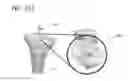 Fig. 45 - Bone positioning device and method