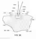 Fig. 09 - Medical kit for constricting tissue or a bodily orifice, for example, a mitral valve