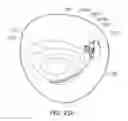 Fig. 35 - Medical kit for constricting tissue or a bodily orifice, for example, a mitral valve