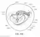 Fig. 43 - Medical kit for constricting tissue or a bodily orifice, for example, a mitral valve