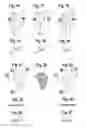 Fig. 08 - Orthotic foot device with removable support components and method of making same