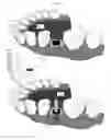 Fig. 02 - Method and kit for producing dental implant drilling guides