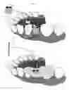 Fig. 06 - Method and kit for producing dental implant drilling guides