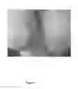 Fig. 02 - Triptans for the treatment of psoriasis