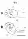 Fig. 02 - Method and device to alleviate carpal tunnel syndrome and dysfunctions of other soft tissues