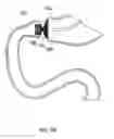 Fig. 71 - Modular gastrointestinal prostheses