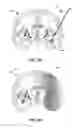 Fig. 03 - SYSTEMS AND METHODS FOR OPTOGENETIC MODULATION OF CELLS WITHIN A PATIENT