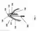Fig. 02 - Method and system for treatment of internal nasal valves