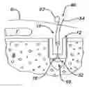 Fig. 01 - Surgical filament snare assemblies