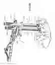 Fig. 48 - Pedicle screw extension for use in percutaneous spinal fixation