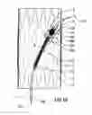Fig. 09 - Stent graft with integral side arm