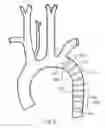 Fig. 06 - Thoracic graft having yarn modifications