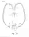 Fig. 03 - Ventilation interface for sleep apnea therapy
