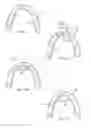 Fig. 02 - Universal oral appliance with a universal coupler