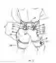 Fig. 09 - Method for correcting pathological configurations of segments of the lower extremities and device for realizing same