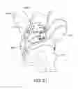 Fig. 22 - System for positioning a cutting guide in knee surgery